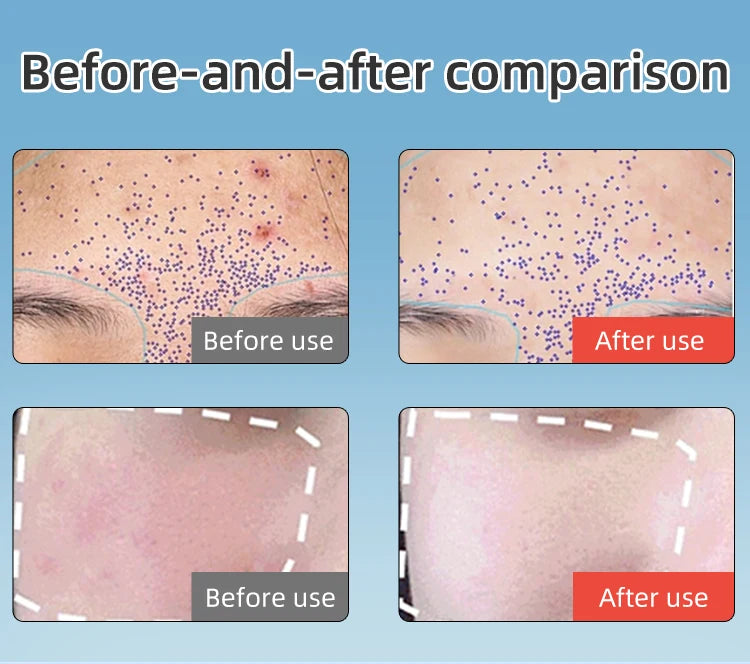 LED Face Mask and Red Light Therapy Device for Skin Rejuvenation and Firming - 12