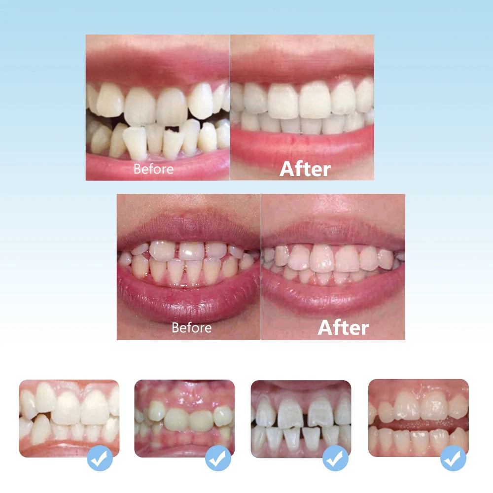 Dental Orthodontic Braces and Teeth Straightener for Children During Growing Years