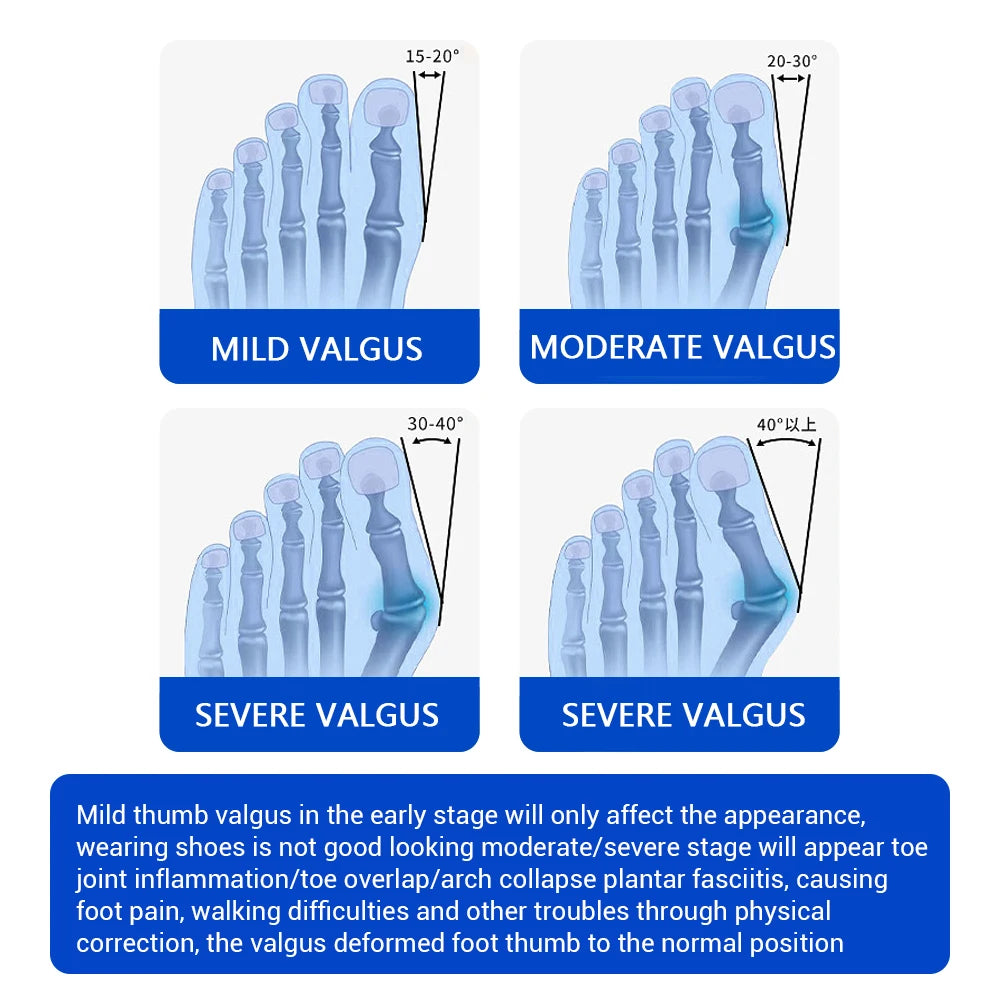 Toe Valgus Corrector and Bunion Splint for Painless Foot Alignment and Comfort - 5