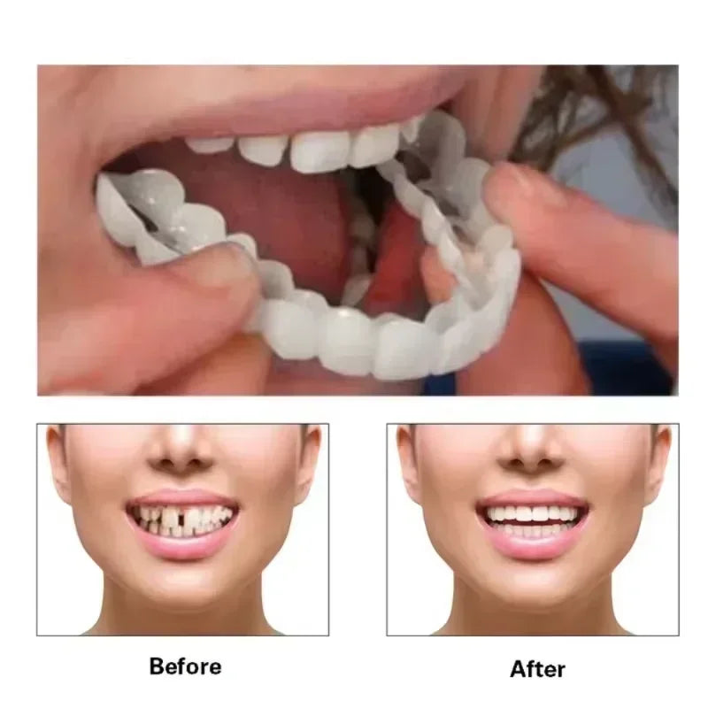 Snap on Veneers and Temporary Fake Teeth for Instant Smile Confidence Results