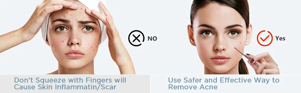 Blackhead Remover Kit and Pimple Popper Tools for Clear Facial Skin Care