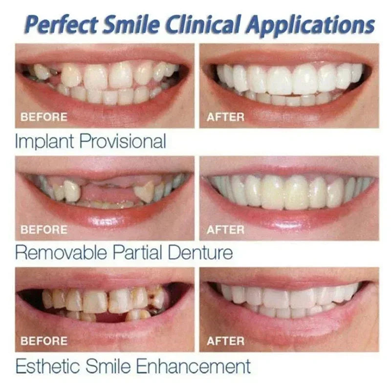 Snap on Veneers and Temporary Fake Teeth for Instant Smile Confidence Results - 4