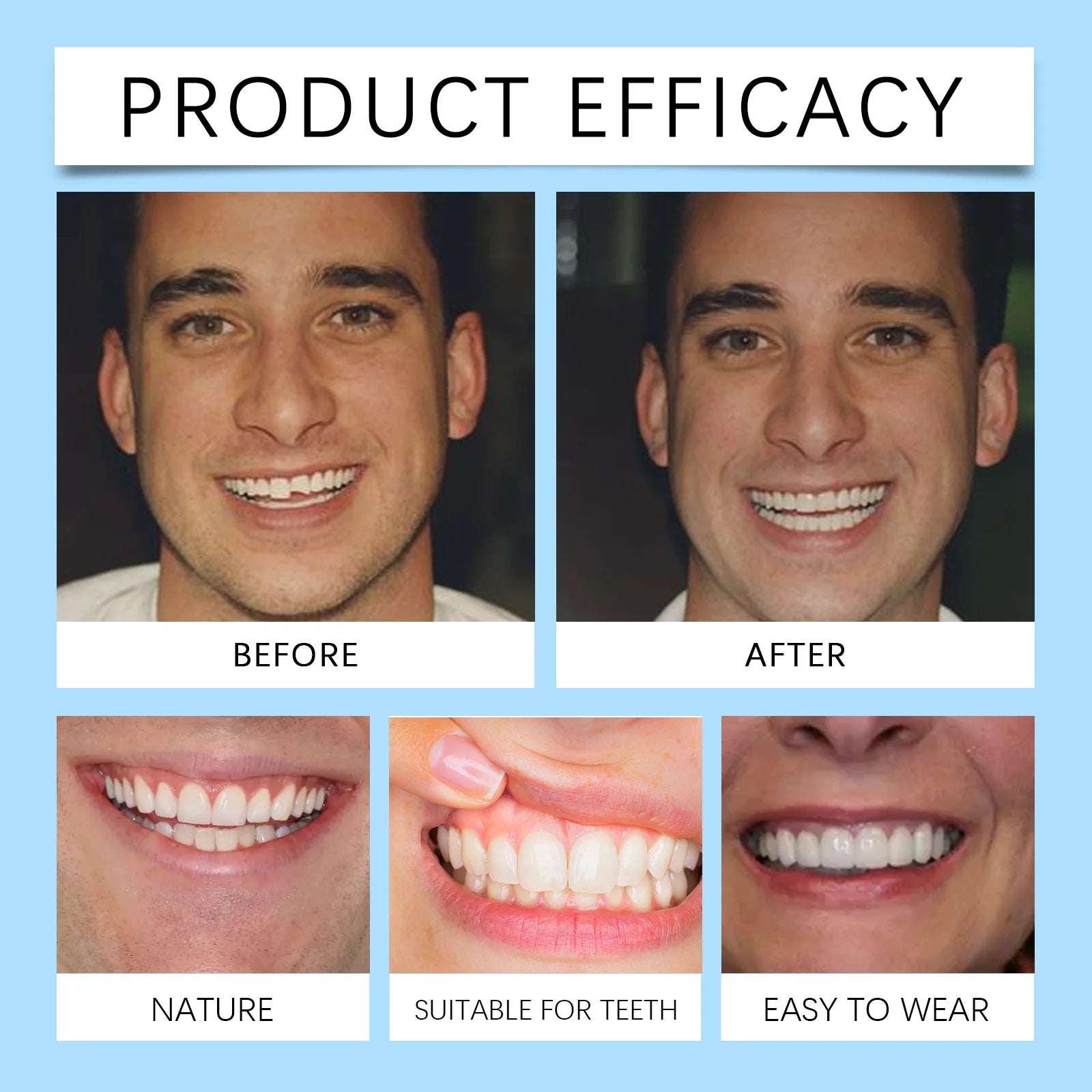 Full Denture Set and Temporary Dental Veneers for Natural Smile and Tooth Restoration - 4