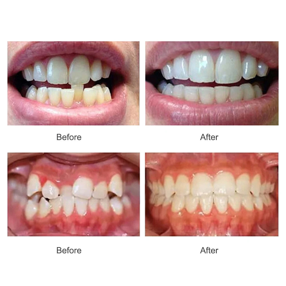 Dental Braces and Teeth Trainer Alignment Mouthpiece for Adult Orthodontic Correction