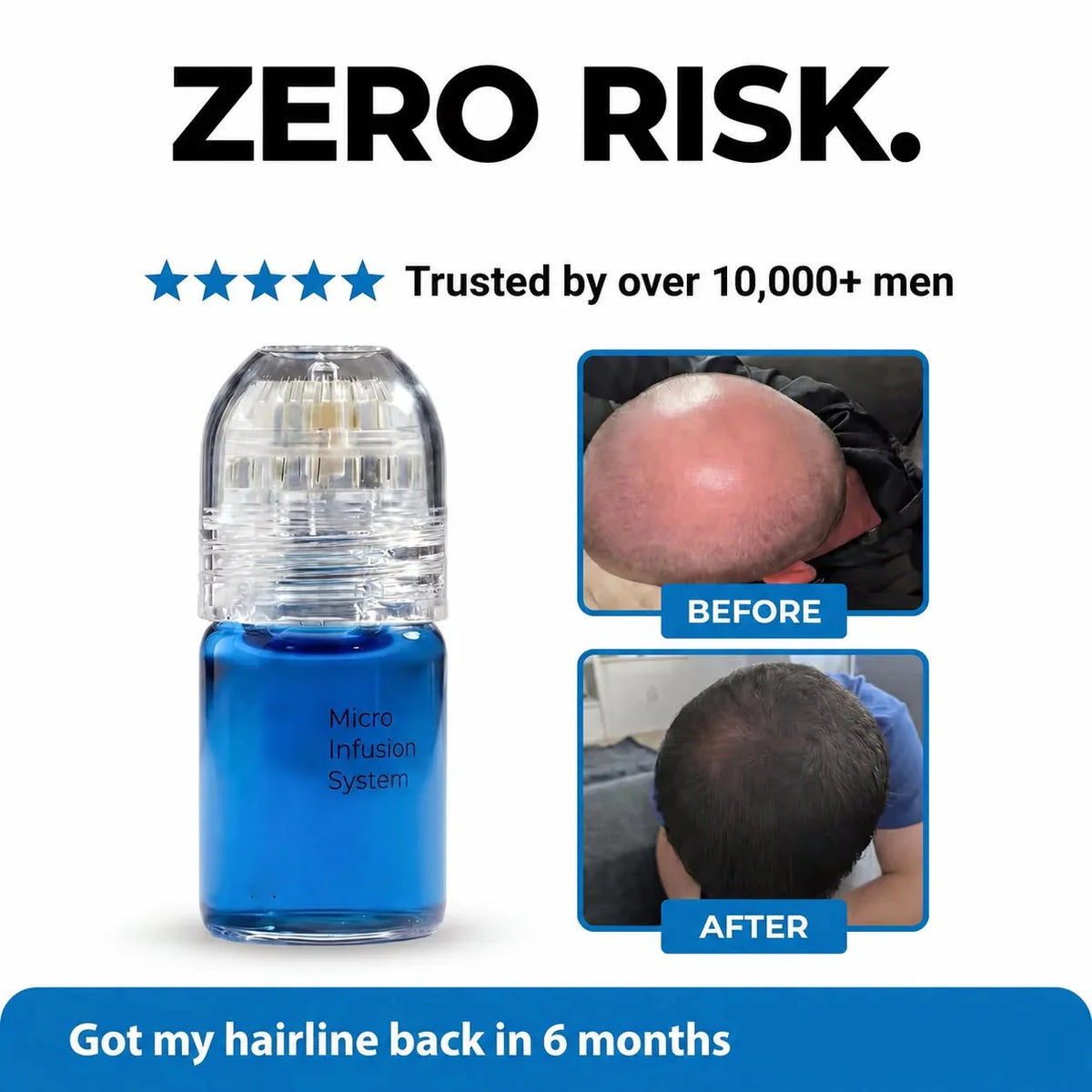 Microneedle Hair Regrowth Kit and Scalp Nourishing Serum for Thinning Hair